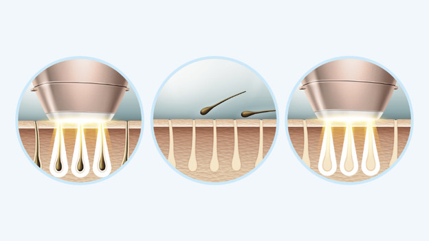 Was ist IPL-Haarentfernung?