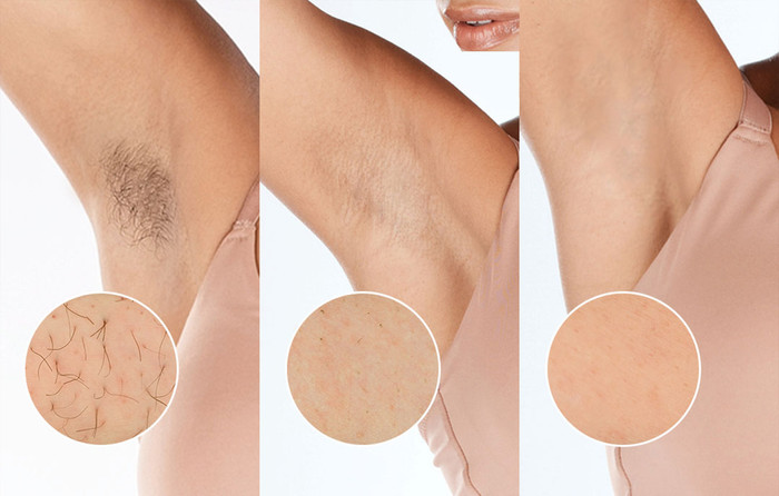 Philips Lumea IPL 9900 Series BRI951/01 visueller lieferant